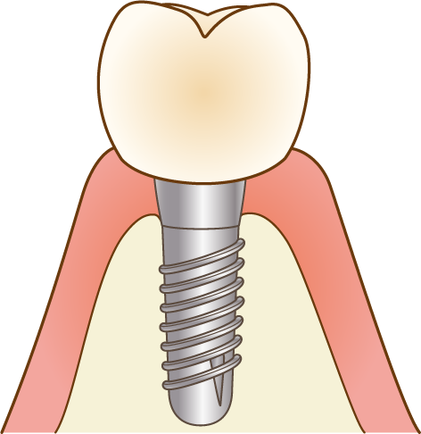 インプラント