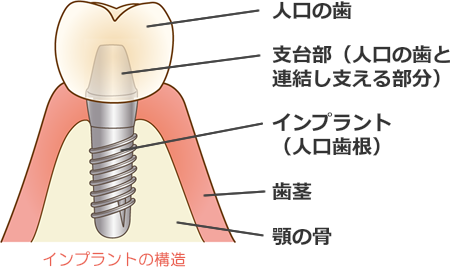 インプラント構造図