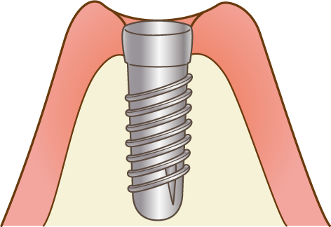 インプラント埋入