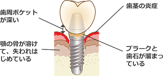 インプラント歯周炎