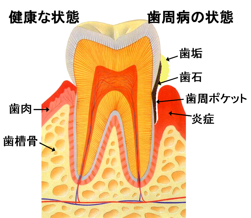 歯周病とは いずみ中山歯科