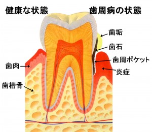 歯周病イラスト