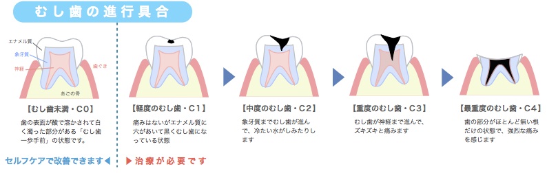 う蝕進行図